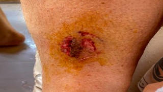 Göcek'te denize giren kadını caretta ısırdı